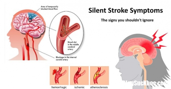 dau hieu canh bao dot quy ngoisaovn 1 ngoisao.vn  Những dấu hiệu báo trước cơn đột quỵ hãy tự biết mà đề phòng