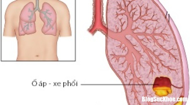 empyema 1414730298955 Nguyên nhân và cách chữa trị bệnh áp xe phổi hiệu quả