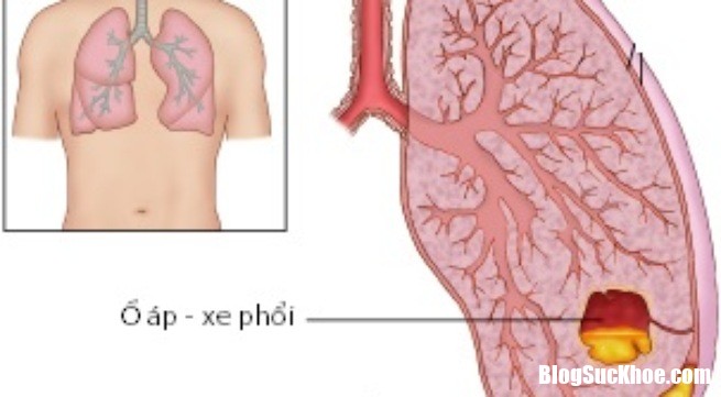 empyema 1414730298955 Nguyên nhân và cách chữa trị bệnh áp xe phổi hiệu quả