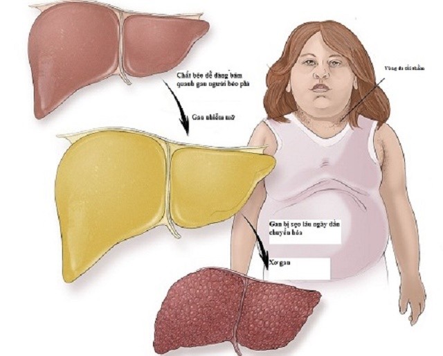 graphic fatty liver 4720 1510281872 Dân văn phòng có nguy cơ cao mắc gan nhiễm mỡ, nguyên nhân do đâu ?