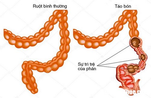 lam dung thuoc dieu chinh nhu dong ruot co th gay tao bon resize Những loại thuốc trị bệnh đường tiêu hóa lại có hại cho đường tiêu hóa