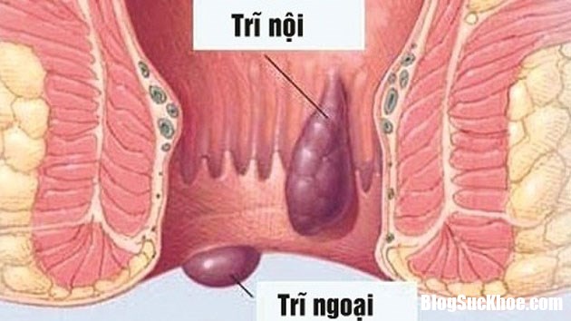 nguyen nhan va cach xu tri khi di ngoai ra mau anh 1 Những nguyên nhân phổ biến gây nên tình trạng đi ngoài ra máu