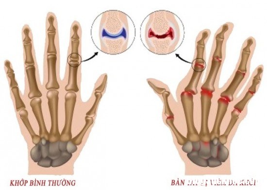 nguyen nhan va phong ngua viem da khop dang thap 1.png Nguyên nhân và cách phòng trị bệnh viêm đa khớp dạng thấp