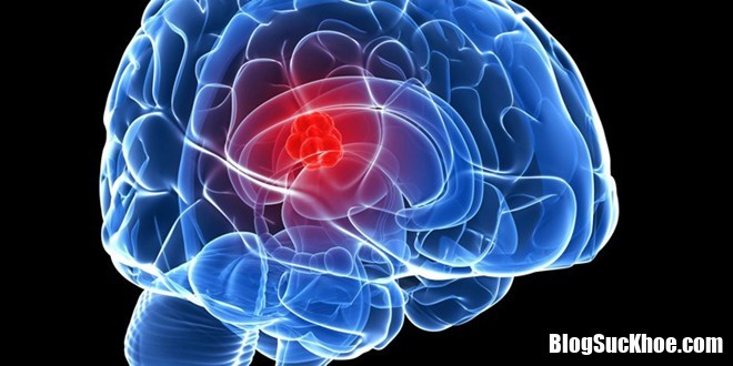 ung thu nao 2 Biểu hiện, triệu chứng và cách phòng trị bệnh não