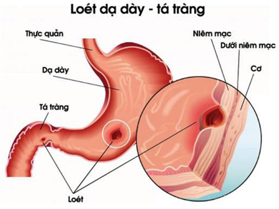 viem loet da day ta trang nen uong thuoc gi Những triệu chứng báo hiệu bệnh viêm loét dạ dày