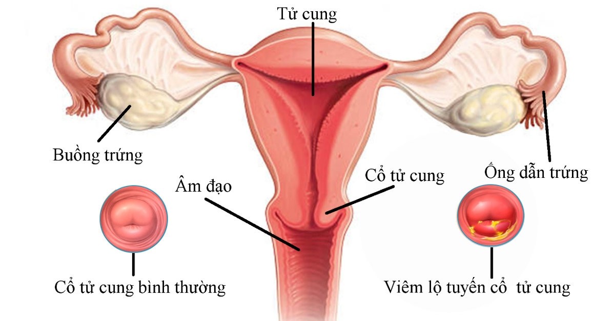 162301viem lo tuyen co tu cung Những dấu hiệu của bệnh cơ tuyến tử cung