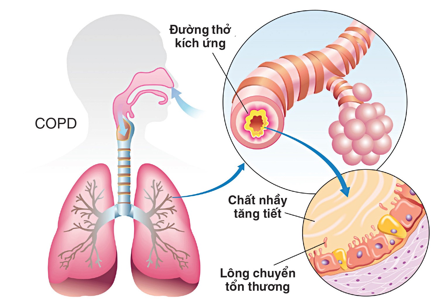 Bien chung cua benh phoi Bệnh phổi tắc nghẽn mạn tính và những biến chứng nguy hiểm