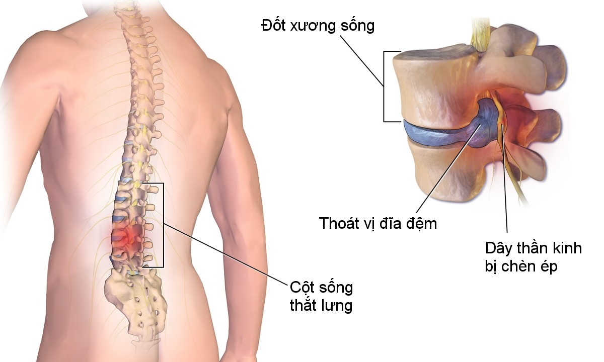 benh hoc thoat vi dia dem 2 Cùng tìm hiểu nguyên nhân và cách phòng bệnh thoát vị đĩa đệm