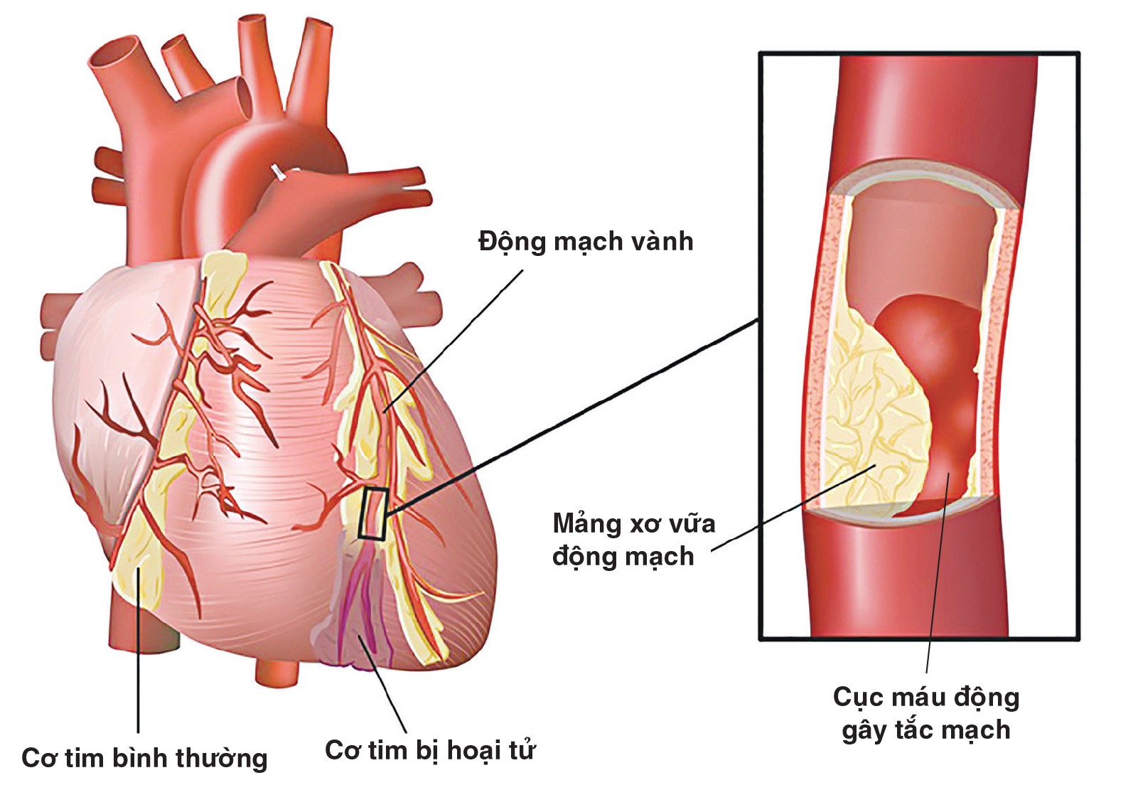 benh dong mach vanh 1 Nguyên nhân và triệu chứngư nhận biết bệnh động mạch vành