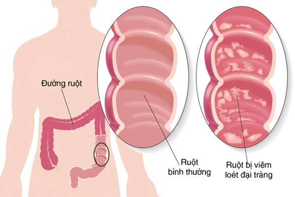 doi pho voi viem dai trang 1 Cách nhận biết viêm đại tràng