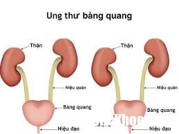 index 3 U bàng quang này có nguy hiểm không? Và nguy hiểm như thế nào?