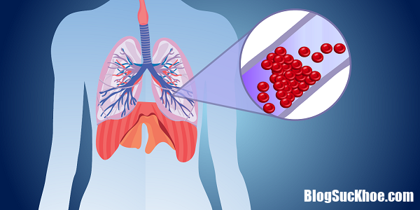 nhoi mau phoi la gi1 Nhồi máu phổi   Một biến chứng nguy hiểm của bệnh tim mạch