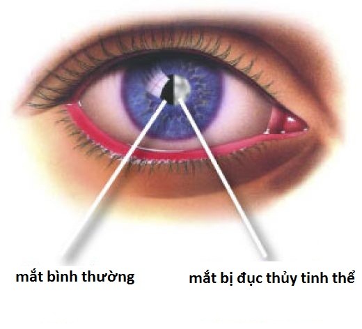 nhung benh o mat co the dan den mu loa Người già và những căn bệnh về mắt nguy hiểm nhất