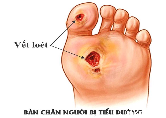 phong bien chng ban chan 1 Những dấu hiệu báo trước của bệnh đái tháo đường