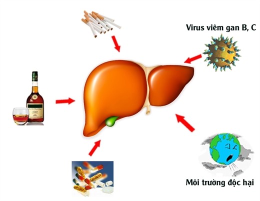 trieu chung ung thu gan hinh 1 281637529.png Phát hiện sớm bệnh ung thư gan thông qua những dấu hiệu trên cơ thể