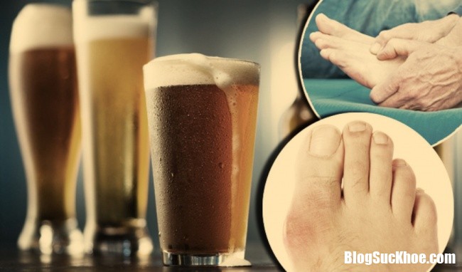 uong bia co lam tang nguy co mac benh gout11522049260 Uống bia thường xuyên có thể làm tăng nguy cơ mắc bệnh gout