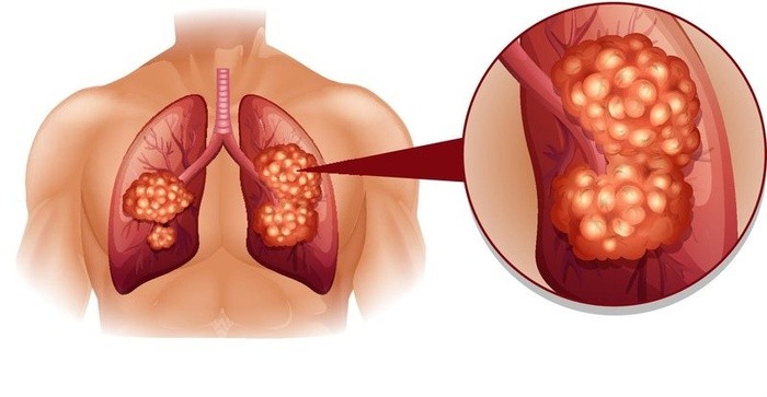 1 161545917 Ngăn ngừa ung thư phổi bằng những loại rau củ thần kỳ nhà nào cũng có sẵn trong bếp