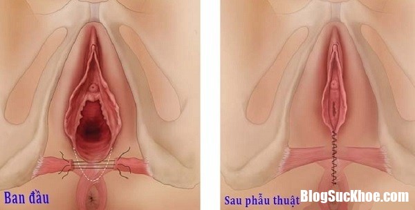 rach tang sinh mon noi am anh cua viec de thuong 03 164049948 Rạch tầng sinh môn   Các bà mẹ chăm sóc và hồi phục như thế nào?