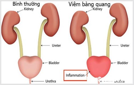 2 oxfo Người lớn tuổi tiểu đêm nhiều lần: Nguyên nhân từ đâu và chữa trị thế nào?