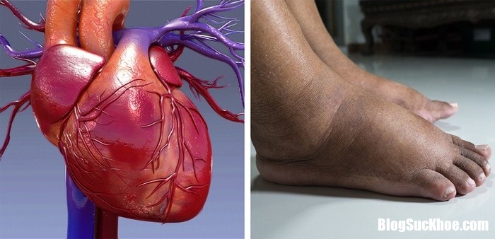 2 things your swollen feet and ankles are trying to tell you about your health 14121863 Bàn chân sưng lên là dấu hiệu các bệnh tim mạch