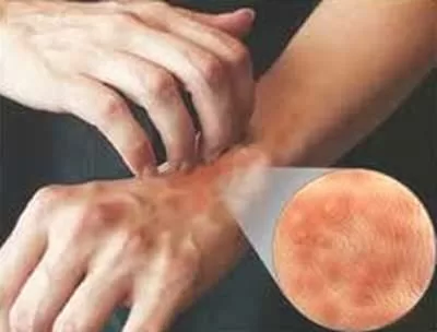 Nắng nóng.. rất dễ bị chứng viêm da