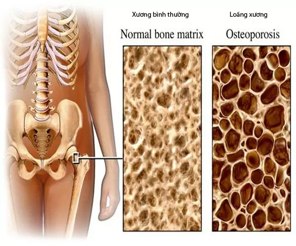 Dự phòng và điều trị loãng xương