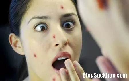 Nguyên nhân và cách điều trị mụn ở tuổi dậy thì