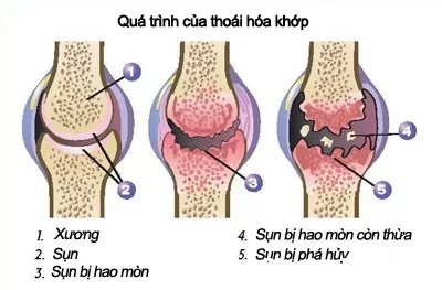 Phòng ngừa thoái hóa khớp