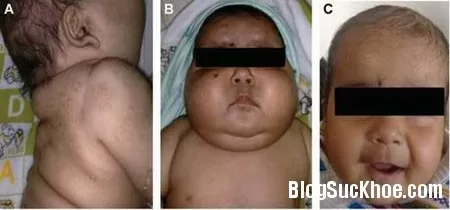 Glucocorticoid - Con dao 2 lưỡi