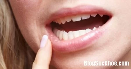 Cách đơn giản chữa viêm loét miệng hiệu quả