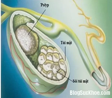 Sỏi mật và những rắc rối với sức khỏe