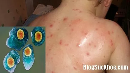 Tổn thương thủy đậu và sởi ở mắt