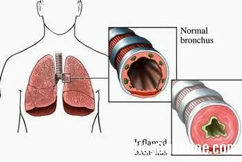 Nguyên nhân gây bệnh hen phế quản