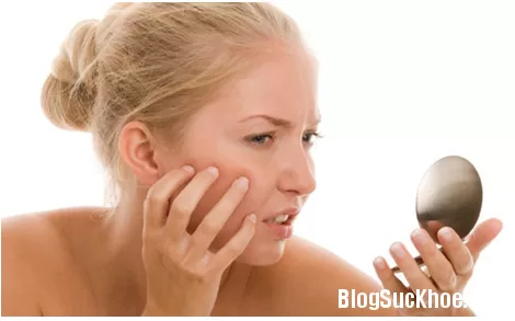 Những điều cần tránh khi mặt bị mụn