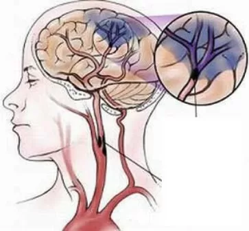 Dấu hiệu nhận biết và nguyên nhân gây xuất huyết não