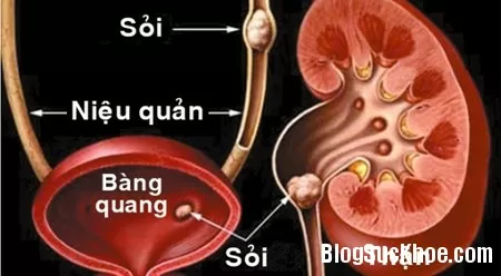 Sỏi mật, nguyên nhân và triệu chứng gây bệnh