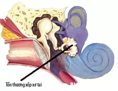 Điều trị xốp xơ tai như thế nào?