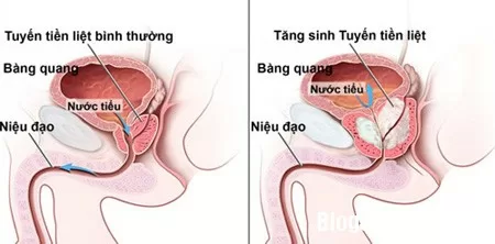 Các bệnh hay gặp của tiền liệt tuyến