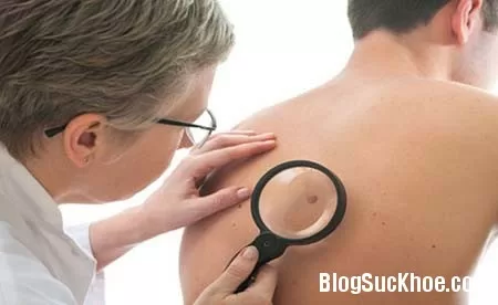 Cần chú ý những dấu hiệu sớm của ung thư da