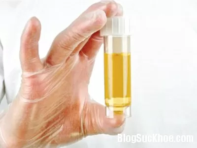 Nguyên nhân gây tiểu ra máu