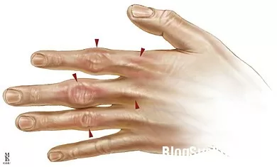 Dấu hiệu bệnh quá tải sắt
