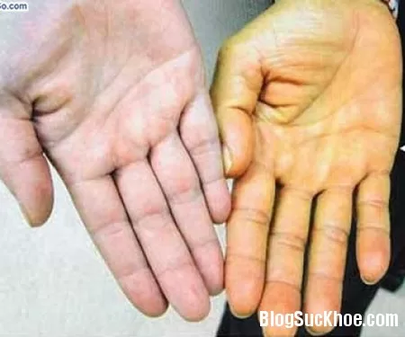 Trị vàng da nhờ Đông y