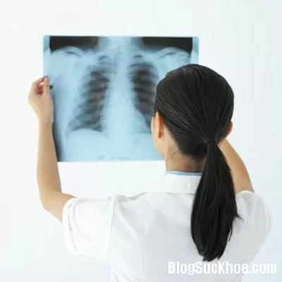 Dấu hiệu cảnh báo sớm bệnh ung thư phổi