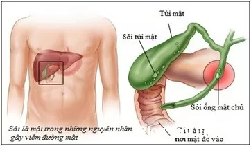 Mẹo đơn giản giúp ngăn ngừa sỏi mật