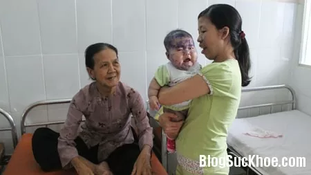 Đầu mùa, trẻ nhập viện thủy đậu bắt đầu tăng