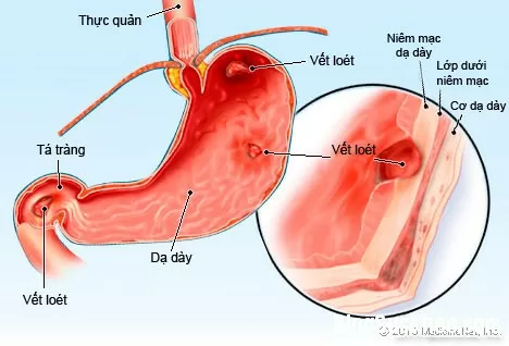 Nguyên nhân và phương pháp điều trị viêm loét dạ dày