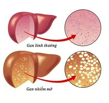 Tăng mỡ máu là gì?