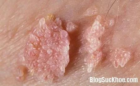 Mắc bệnh tình dục vì ngỡ ô sin là "rau sạch"