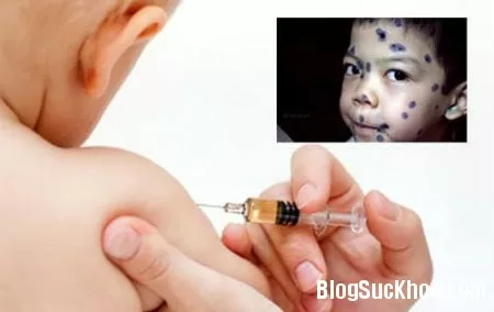 Cảnh giác với dịch thủy đậu