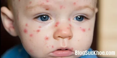 Cách phân biệt giữa bệnh sởi và bệnh thủy đậu